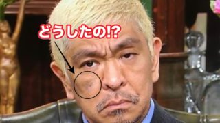 画像 松本人志の顔の右目下頬のあざ シミ や腫れはボトックス 格闘技でケガ 話題hacks